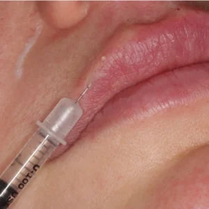 Women receiving dermal filler injection in her upper lip.