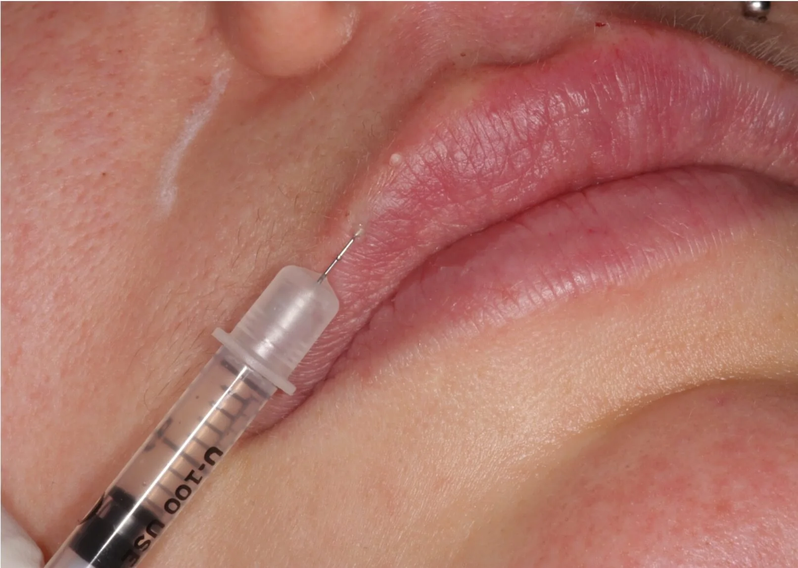 Women receiving dermal filler injection in her upper lip.