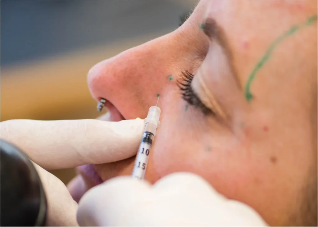 Woman receiving Botox injections in her mid-face/nose area by a dentist.