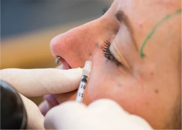 Woman receiving Botox injections in her mid-face/nose area by a dentist.