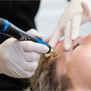A women having a microneedling treatment in a clinic.