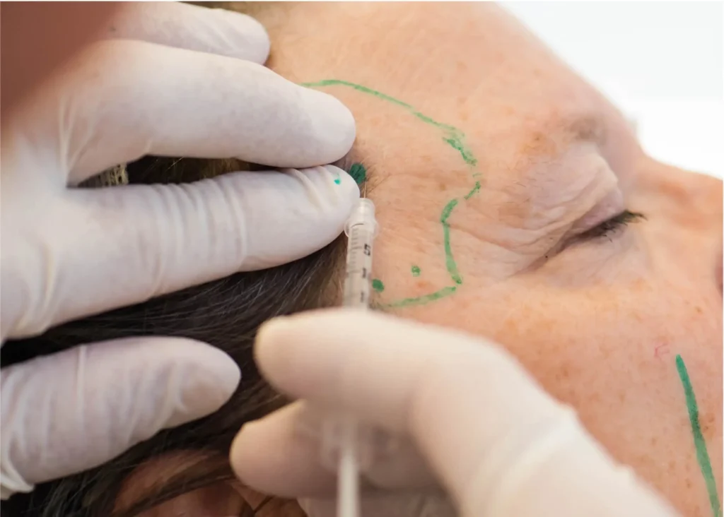 Dentist injecting Botox in the temporalis region of a woman's face for migraine treatment.