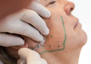 Femme recevant des injections de Botox dans son masséter pour des douleurs de type TMD.