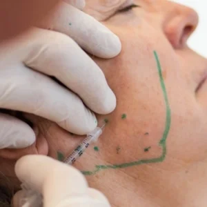 Woman receiving Botox injections in her massater for TMD pain.