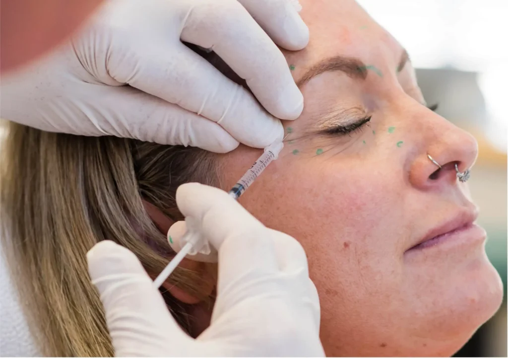 A woman having Botox injections in her upper face.
