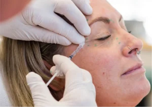 A woman having Botox injections in her upper face.