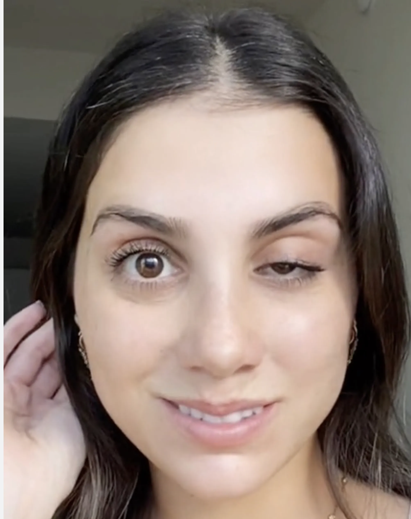 Botox ptosis Women experiencing Botox ptosis.